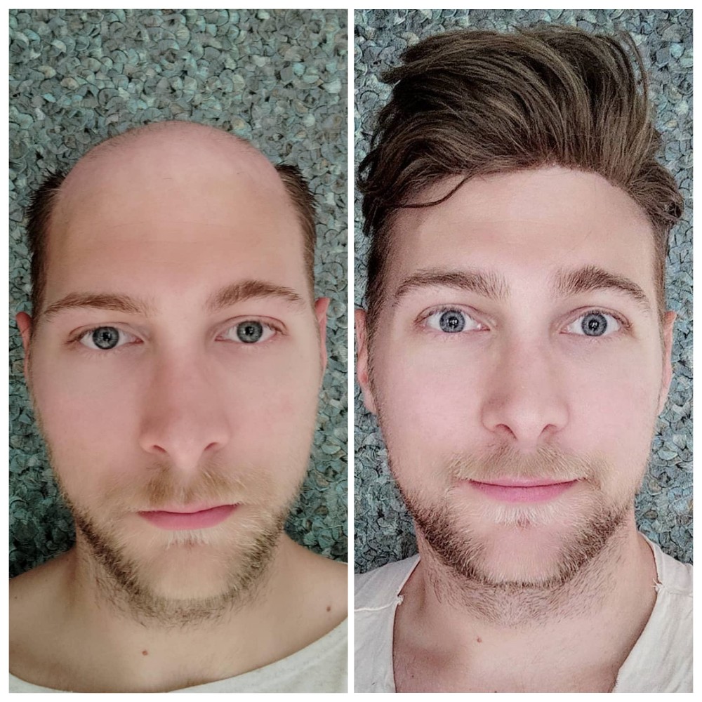 human hair replacement system