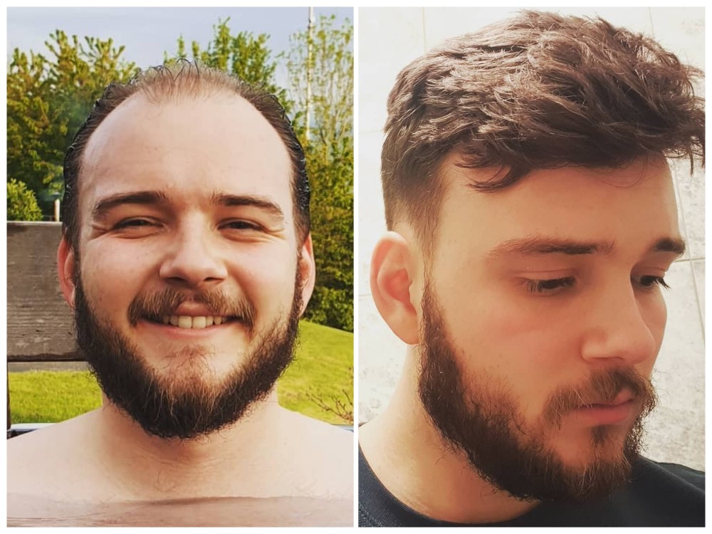 hair system before and after