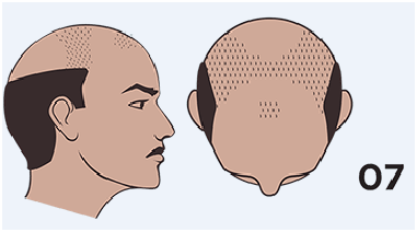 hair loss stage 7