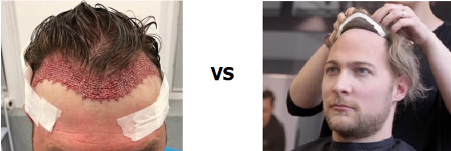 hair transplant vs hair system