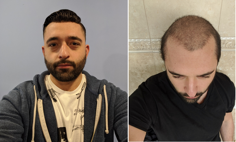 mens hair system before and after