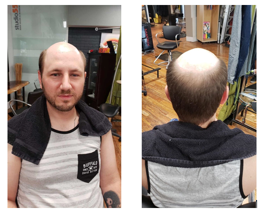 male pattern baldness