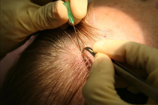 HAIR TRANSPLANT